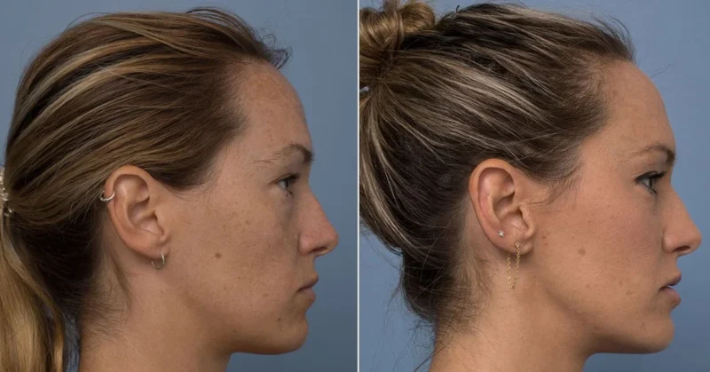 comparing a normal skull and one with a recessd maxilla, highlighting facial structure differences and key symptoms.