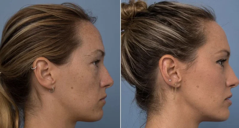 comparing a normal skull and one with a recessd maxilla, highlighting facial structure differences and key symptoms.